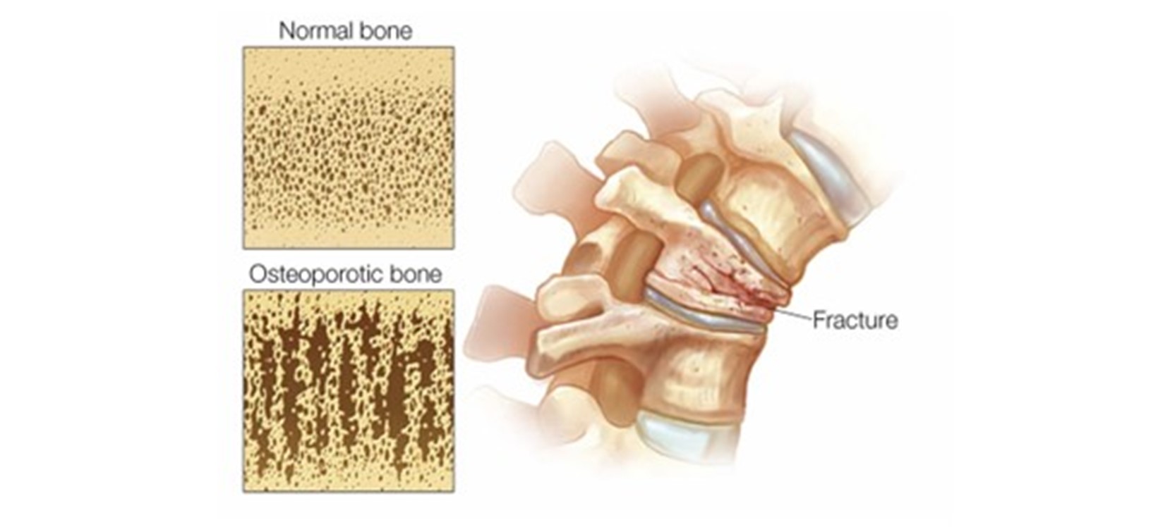 osteoporotic trauma